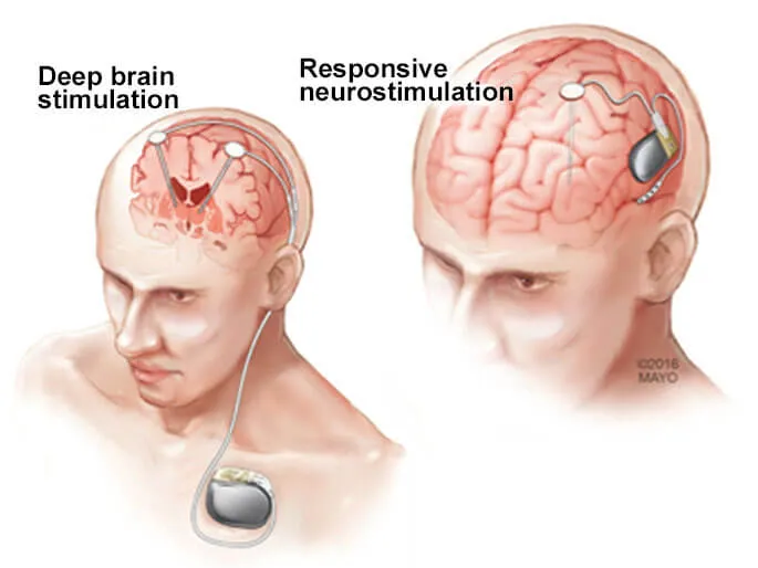 Deep brain simulation in epilepsy patients